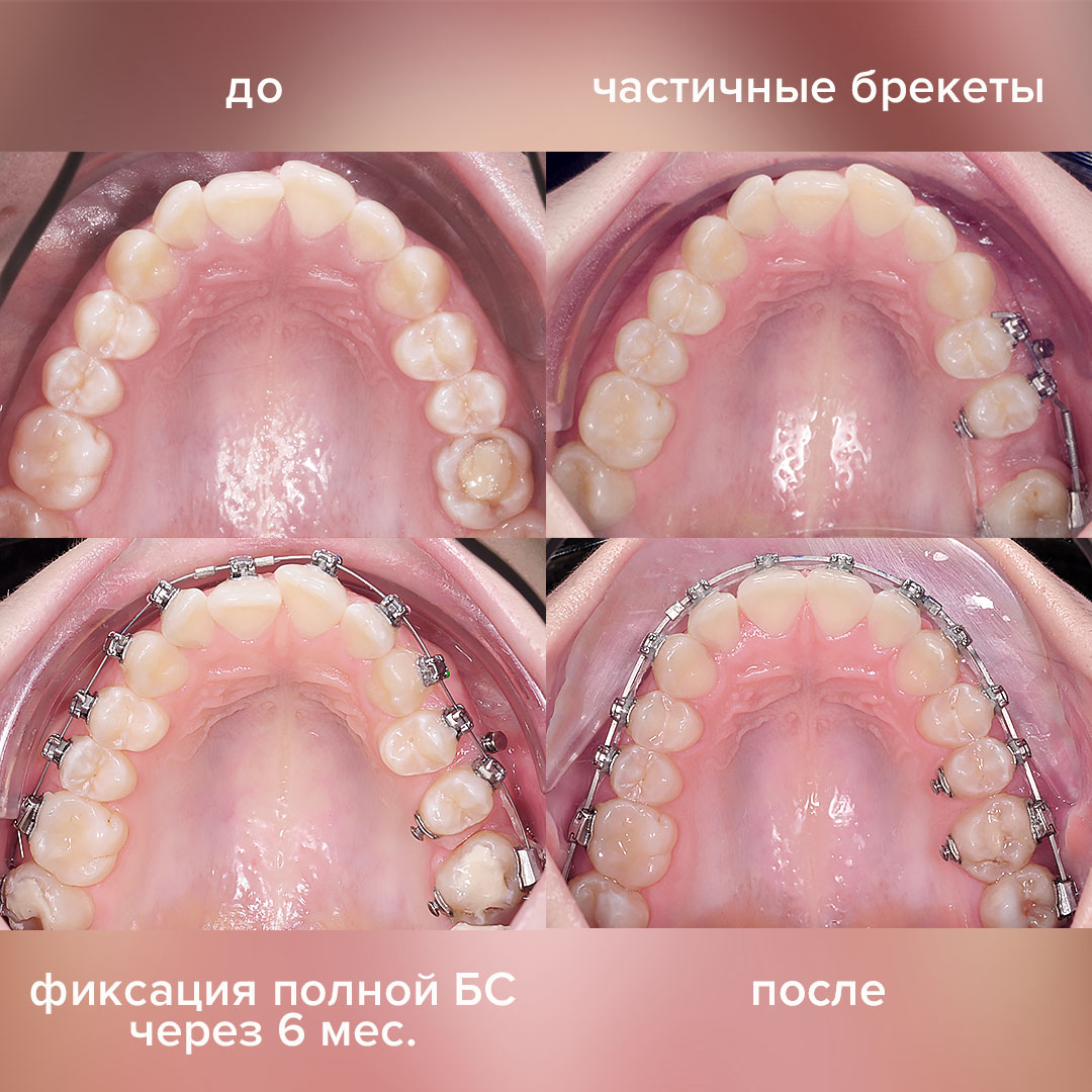 Результаты лечения в Клинике Полный Порядок: закрытие промежутка от  удаленного моляра